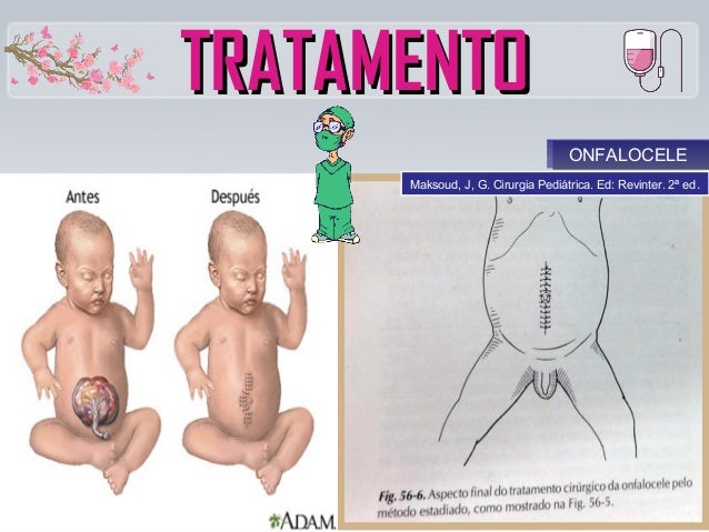 gastrosquise e onfalocele